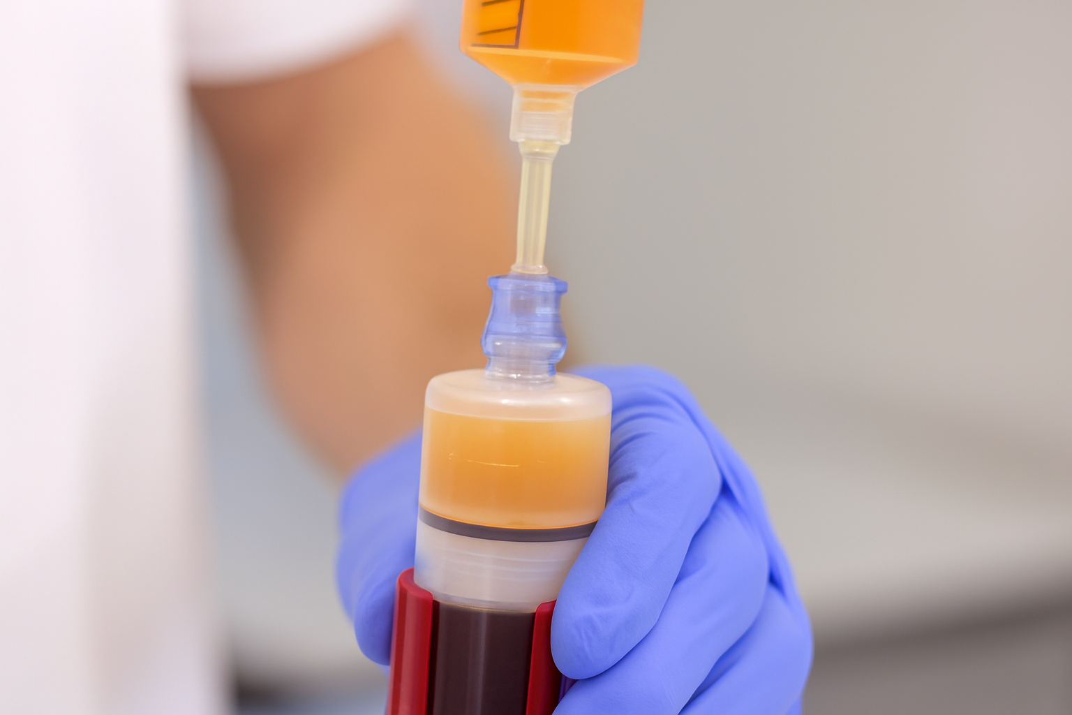 A clinician handling a PRP sample showing visible layers of platelet-rich and platelet-poor plasma during regenerative preparation.