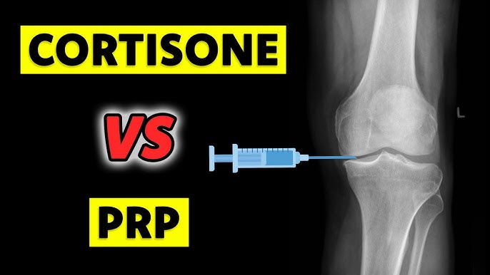 PRP vs Cortisone