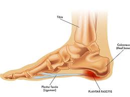 plantar fasciitis