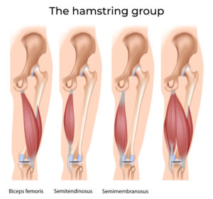 hamstring tendinopathy