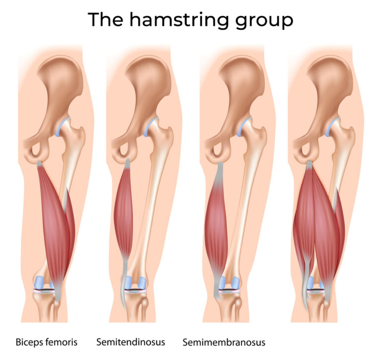 Shockwave for Hamstring Tendinopathy in Boulder, CO